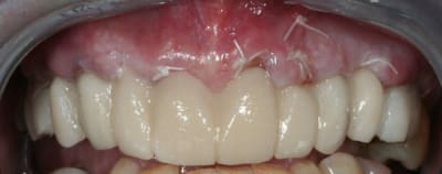 Bridge pro   48 heures rffnd8 - Eugenol