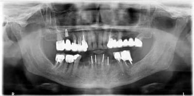 Bridge sur implant nxrp3o - Eugenol