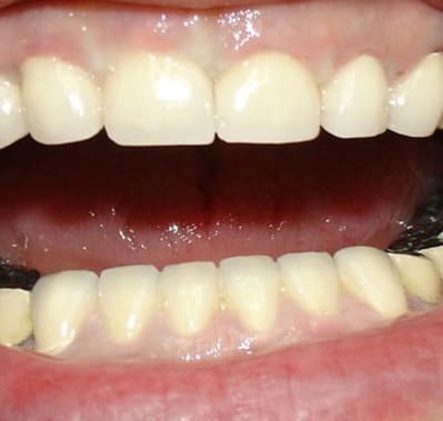 Ccm ht et bs apr s trvx cdaw46 - Eugenol