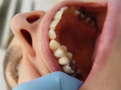 Cerec  encore une pmautre vue ls0etd - Eugenol