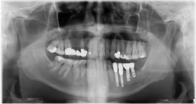 Cherche implant ehvizb - Eugenol