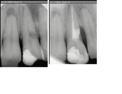 Christophe résorption latérale qxguxc - Eugenol