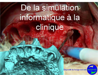 Cicatrisation gingivale suite eimci positdental 8 ryjnyy - Eugenol