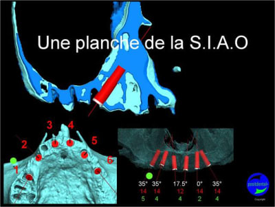 Cicatrisation gingivale suite mci positdental 3 djfvq3 - Eugenol