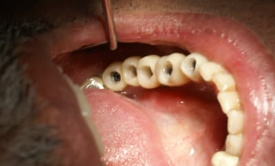 Cinq caries wv0buf - Eugenol