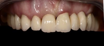 Couronne et bridge nuqbil - Eugenol