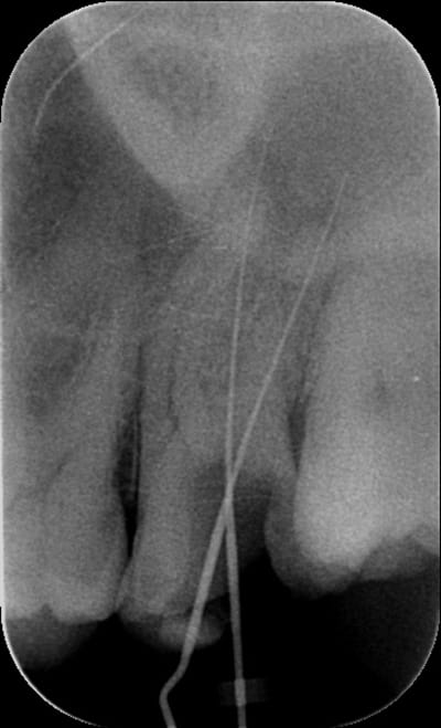 Dépassement jsgfgn - Eugenol