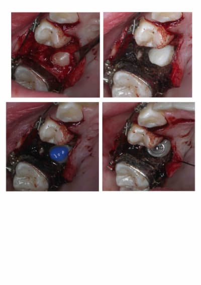 D gagement chir zxcnv2 - Eugenol