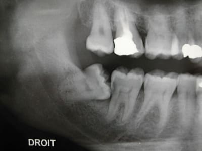Dds deiybo - Eugenol