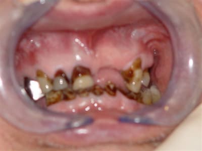 Debut cas global ggdbvs - Eugenol