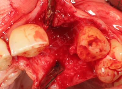 Defekt yenkv5 - Eugenol