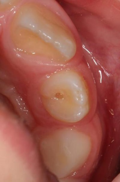 Dens wuevwc - Eugenol