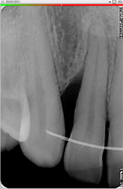 Dent 12 zllmcw - Eugenol