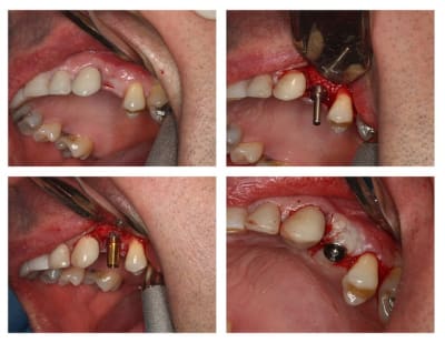 Dent 24 grjphn - Eugenol