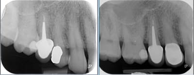 Dent vivante xqxqel - Eugenol