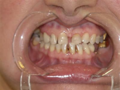 Dentosophie classe iii hxdrwf - Eugenol