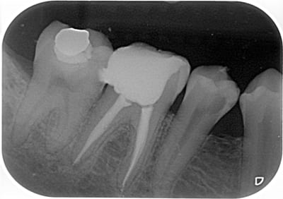 Endo2 dyxj7s - Eugenol