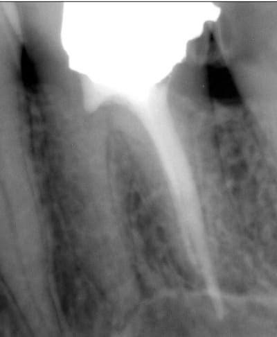 Endo 10  1  preop lwflbk - Eugenol