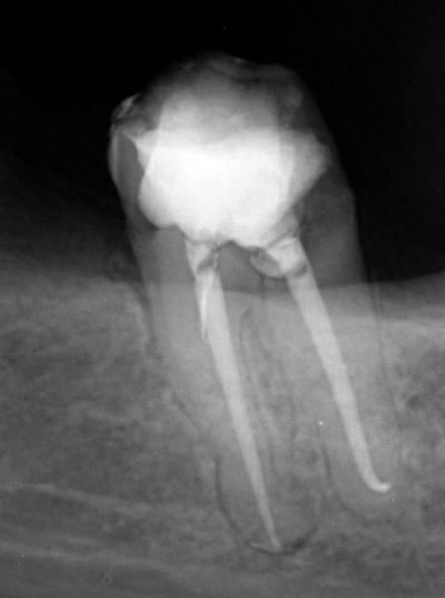 Endo 3  3  fin a4y8gs - Eugenol