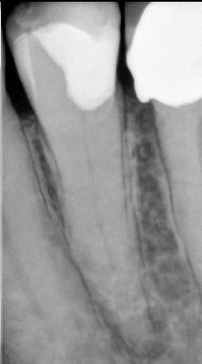 Endo 49  1  preop t5er2c - Eugenol