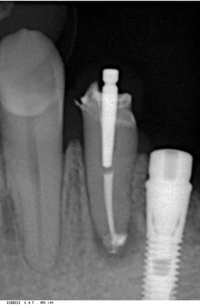 Endo avant xmkdbq - Eugenol