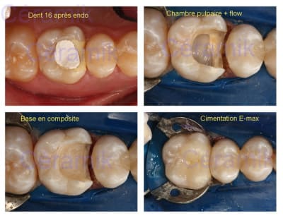 Endo onlay  16  vb7lwv - Eugenol