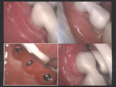 Essai zircone dense sur implants 37  36 et 35 ii vnidco - Eugenol