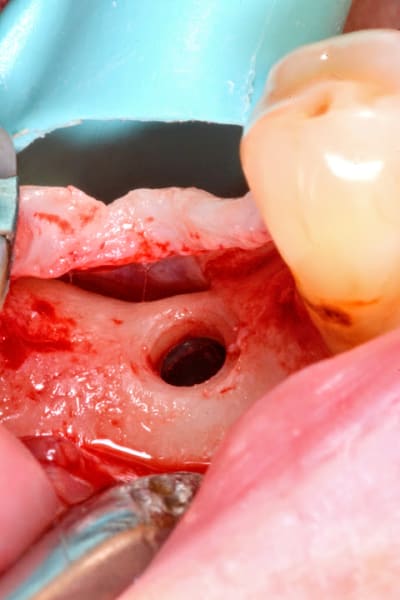 Evaseur 3 us2dkl - Eugenol