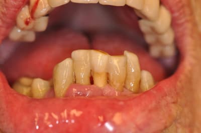 Everstick gu6maz - Eugenol