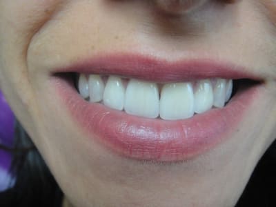Facette celik s 001 ocedxi - Eugenol