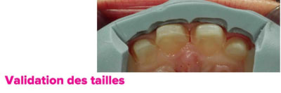 Facettes eugenol - Eugenol