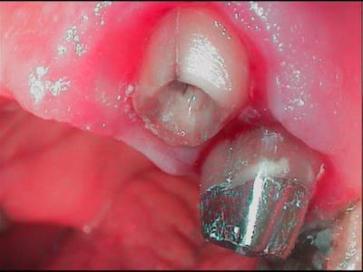 Felure rdjfwb - Eugenol