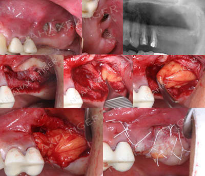 Fermeture cbs boule de bichat kzcupe - Eugenol