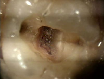 Fissure1 - Eugenol
