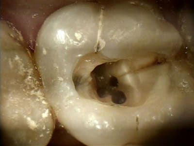 Fissure2 - Eugenol