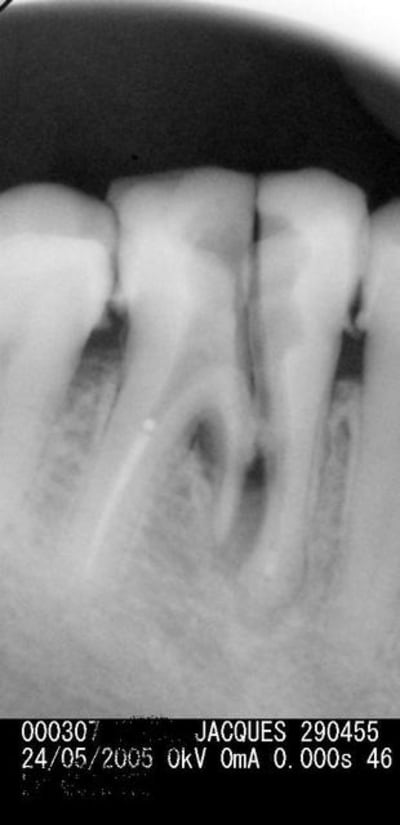 Fissure jfsk3f - Eugenol