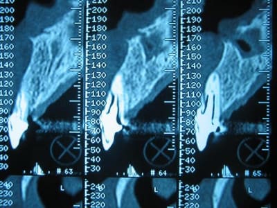 Fracture1 dzggeg - Eugenol