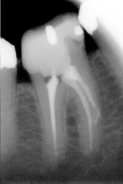 Fracture f87qao - Eugenol