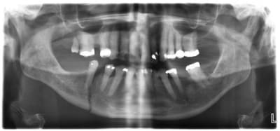 Fraktur1 ssvprb - Eugenol