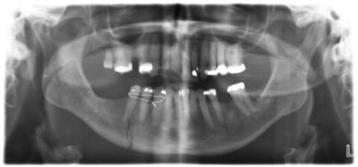 Fraktur2 fwzaac - Eugenol