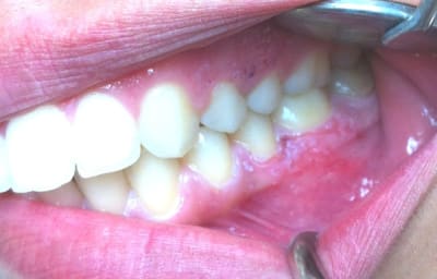 Gingivite1 nmq0lg - Eugenol