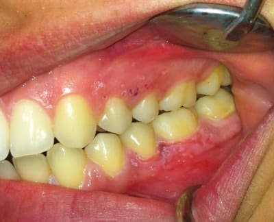 Gingivite2 qxivhx - Eugenol