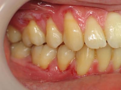 Gingivite ekdoyp - Eugenol