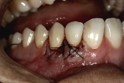 Greffe 004 g3koex - Eugenol