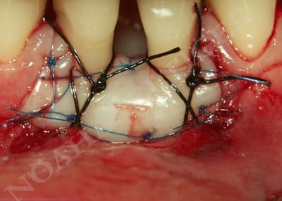 Greffe gingivale libre slhq1i - Eugenol