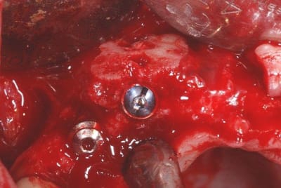 Greffe implantation today oltw75 - Eugenol