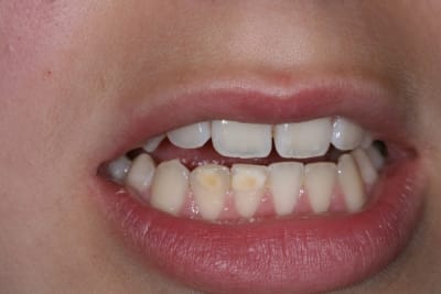Hypoplasie  mail jhrmjg - Eugenol