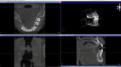 Image radioopaque à droite du conduit rhinopharyngé aa0ig1 - Eugenol