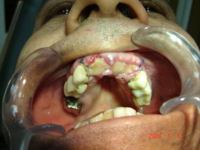 Images cliniques 001 qcp6sh - Eugenol
