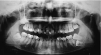 Impacted 3 ynsdhm - Eugenol